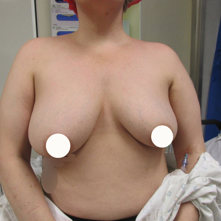4 & a half months post-op (8)