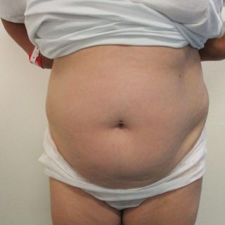 Dr Vucak Liposuction to abdomen Before