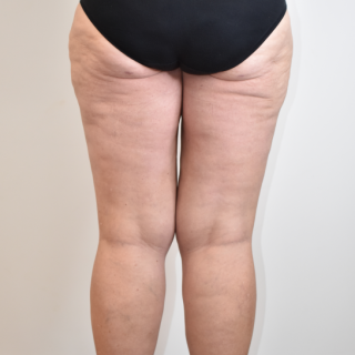 Liposuction to hips, lateral and medial thighs, and knees