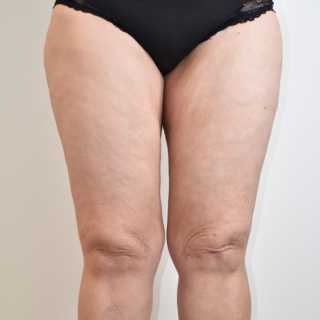 Liposuction to hips, lateral and medial thighs, and knees